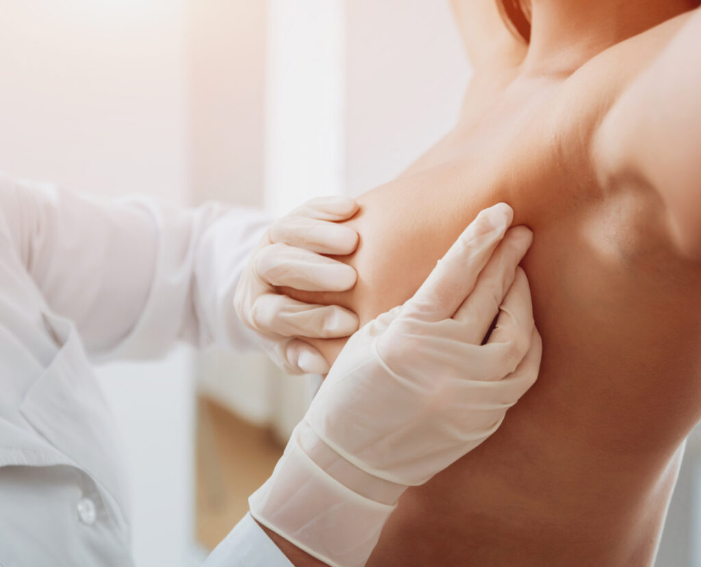 Breast Augmentation - Sotirios Ioannidis