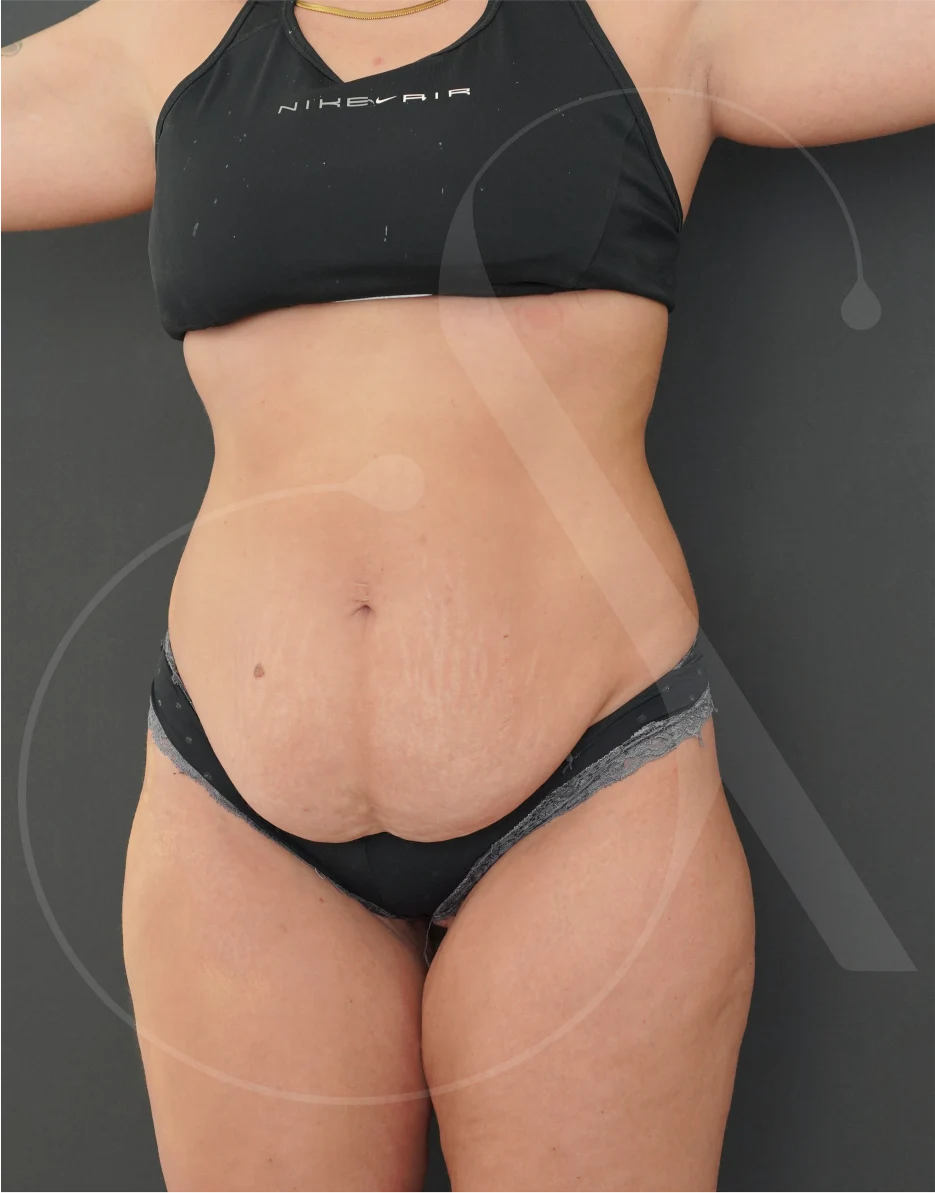 plastic-surgery-clinic-case-study-abdominoplasty-1-1