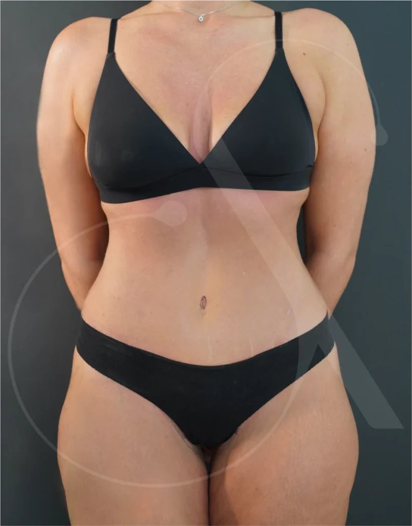 plastic-surgery-clinic-case-study-abdominoplasty-1-10