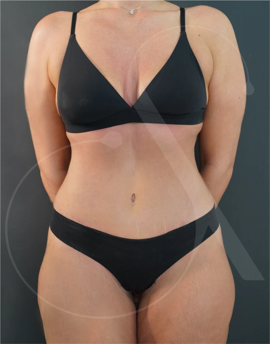 Abdominoplasty – Case 01