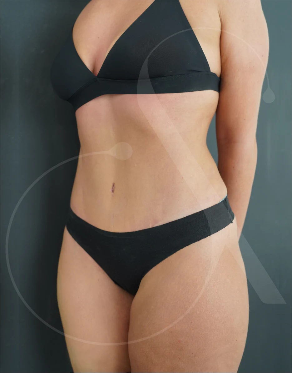 plastic-surgery-clinic-case-study-abdominoplasty-1-2