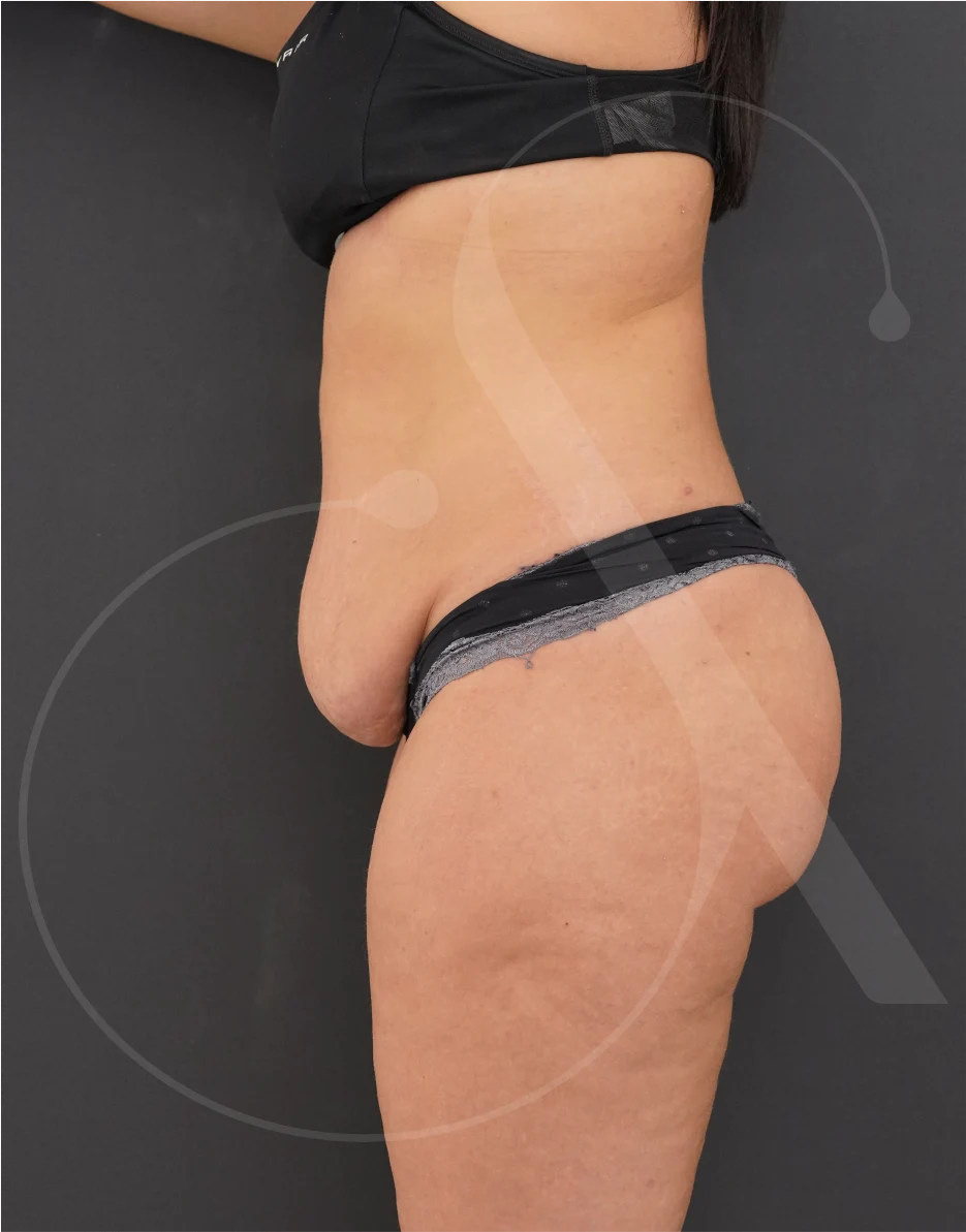 plastic-surgery-clinic-case-study-abdominoplasty-1-5