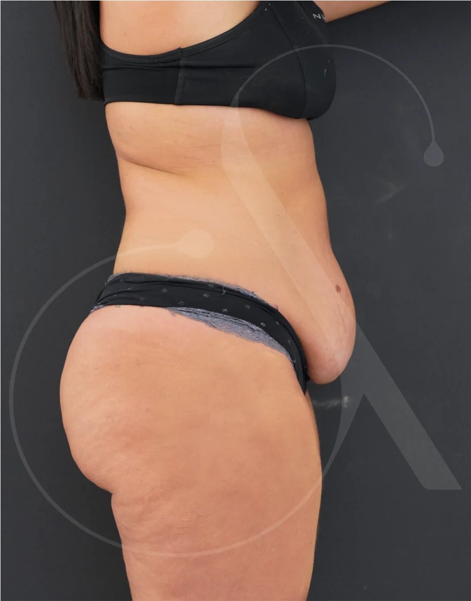 plastic-surgery-clinic-case-study-abdominoplasty-1-7