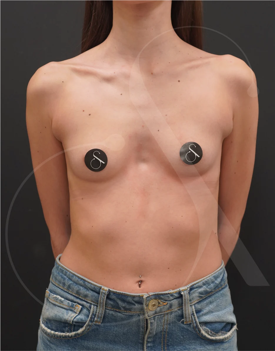 Breast Augmentation – Case 01