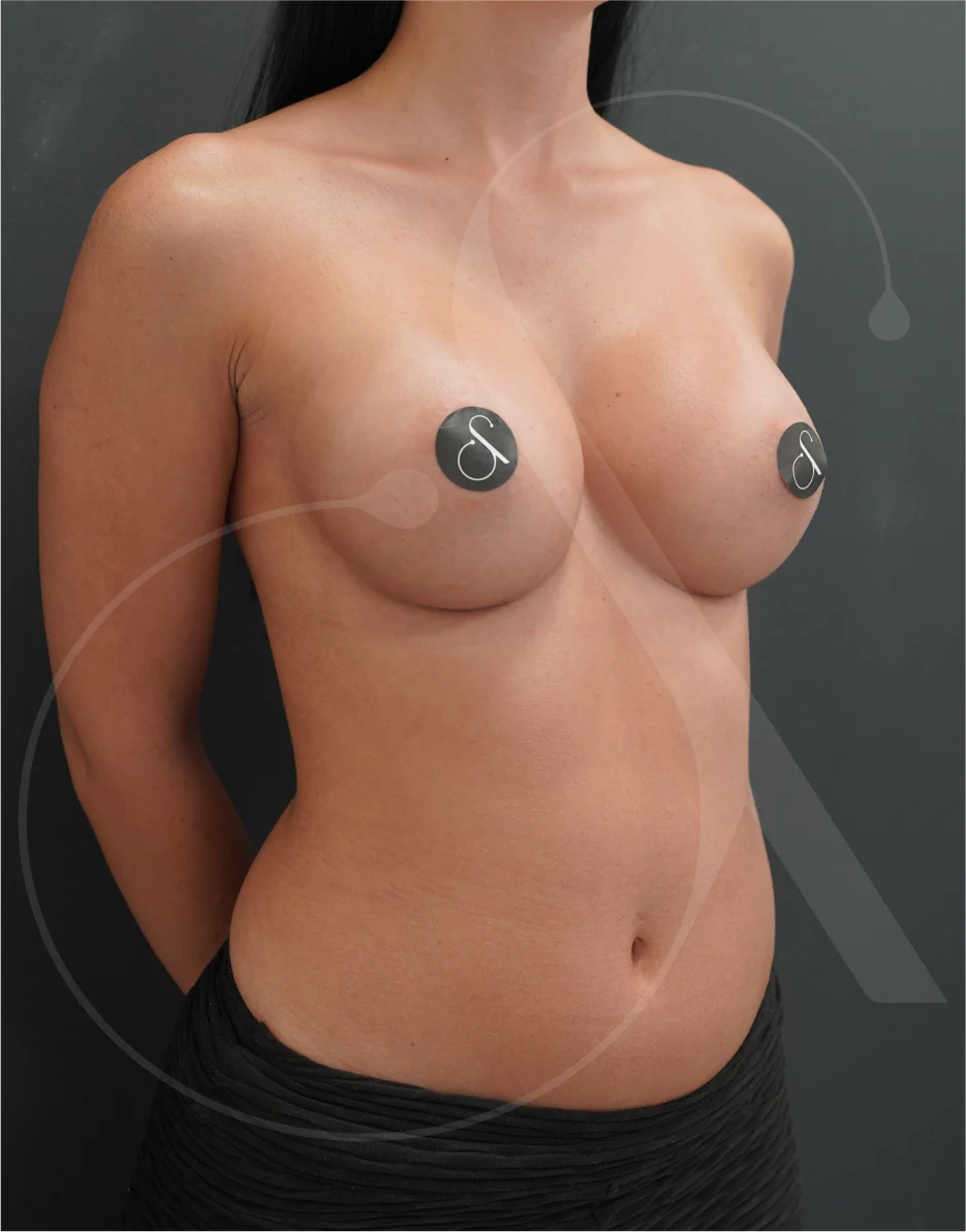 plastic-surgery-clinic-case-study-augmentation-2-10