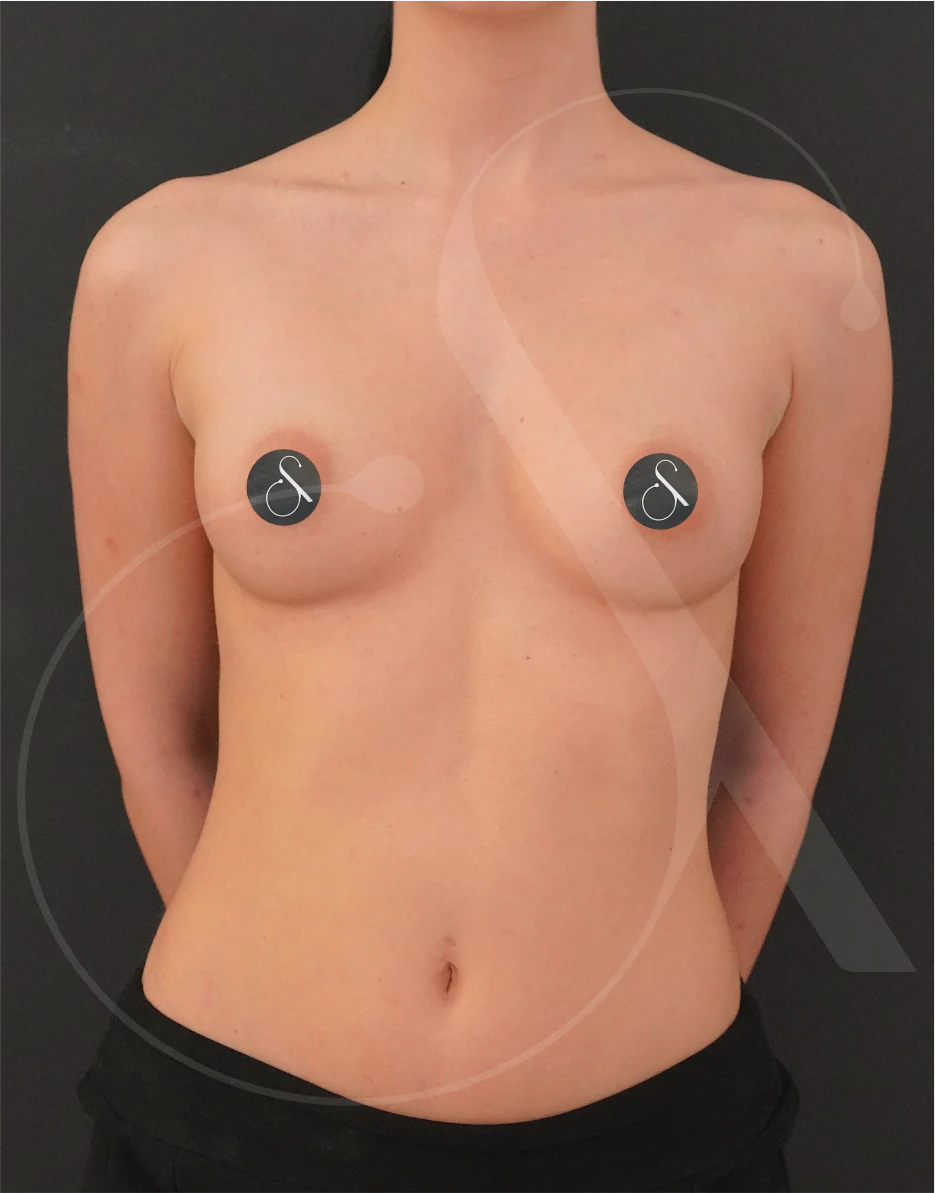 Breast Augmentation – Case 02