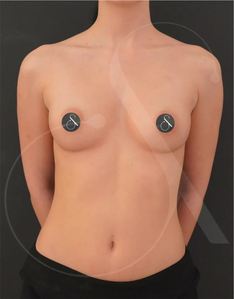 plastic-surgery-clinic-case-study-augmentation-2-3