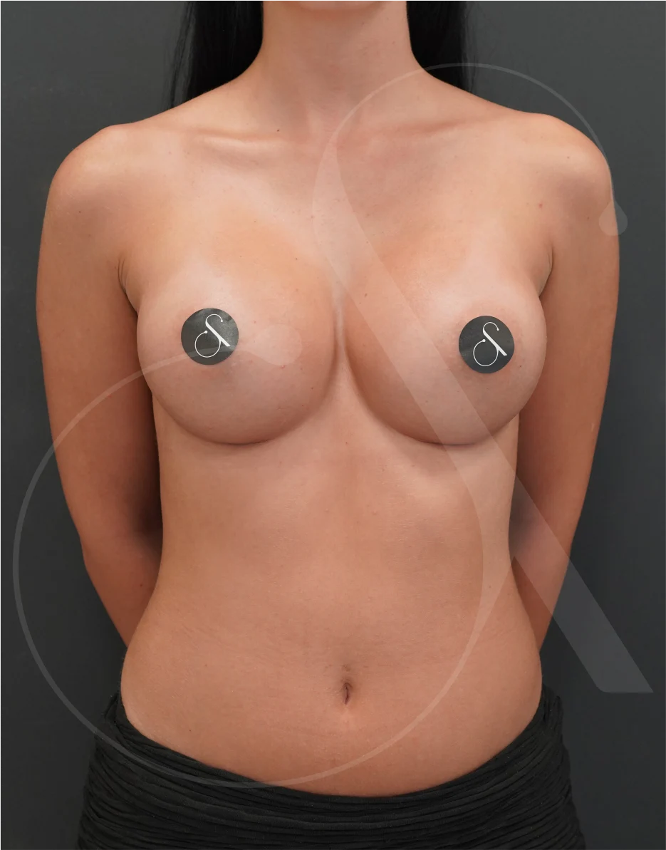 Breast Augmentation – Case 02