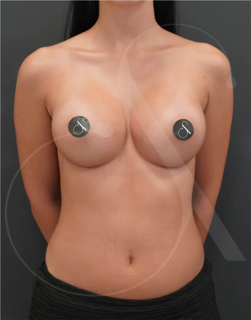 plastic-surgery-clinic-case-study-augmentation-2-4