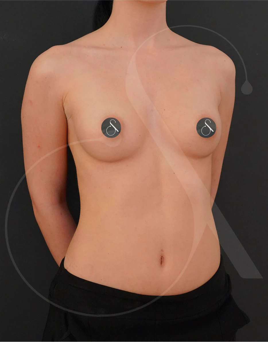 plastic-surgery-clinic-case-study-augmentation-2-9