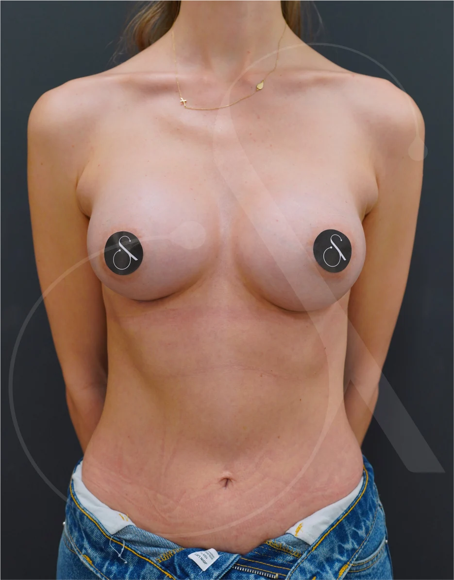 BREAST AUGMENTATION – CASE 03