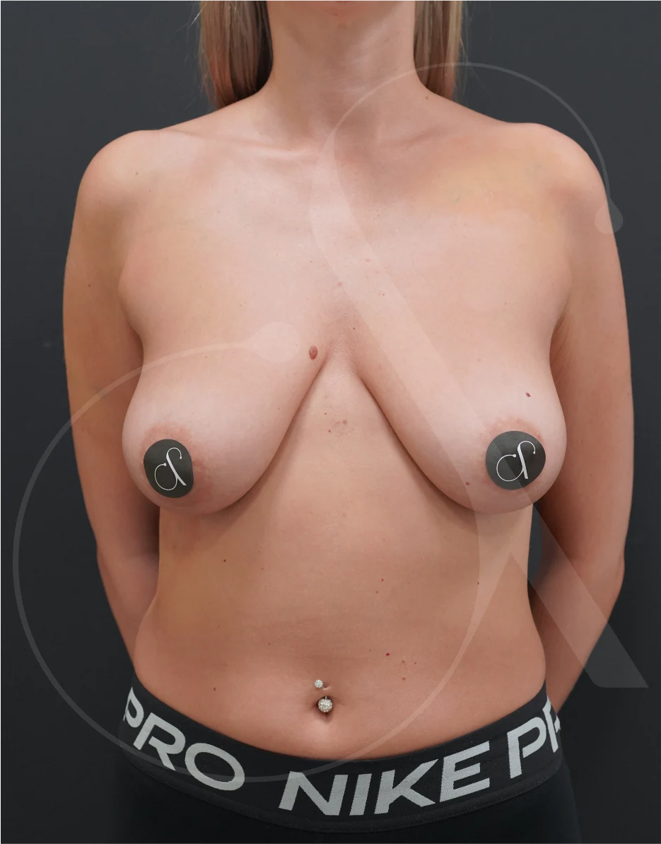 plastic-surgery-clinic-case-study-augmentation-breastlift-2-9