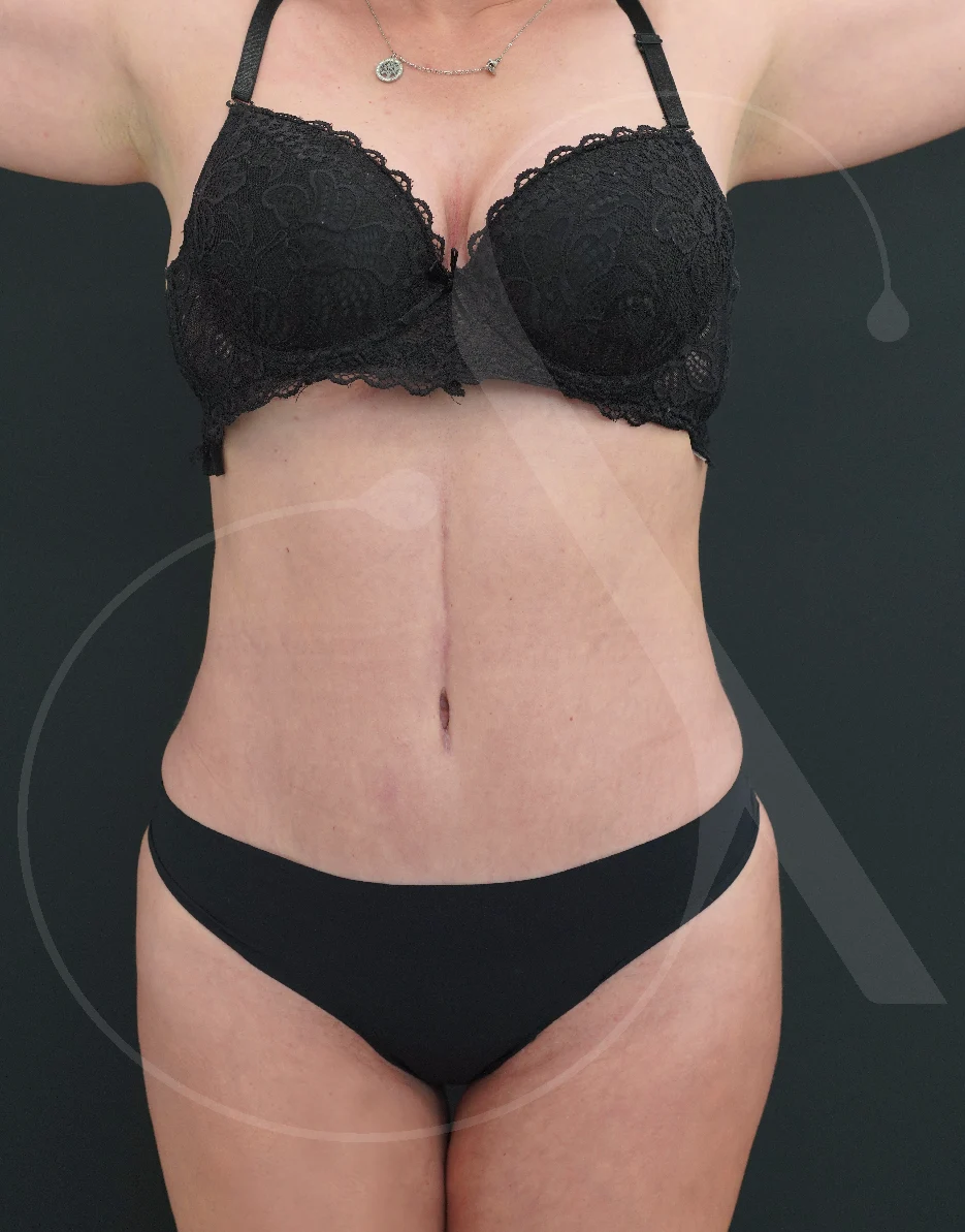 Abdominoplasty – Case 02