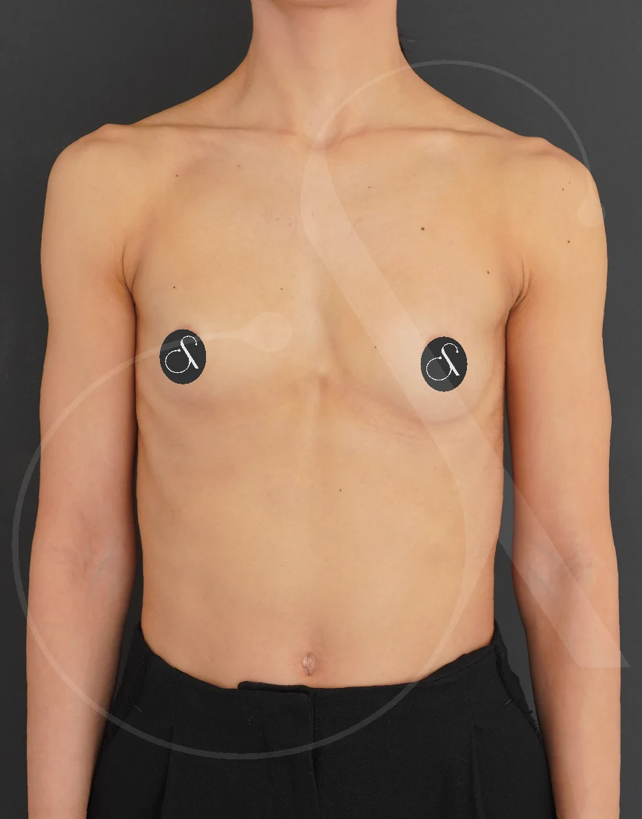 Breast Augmentation – Case 20