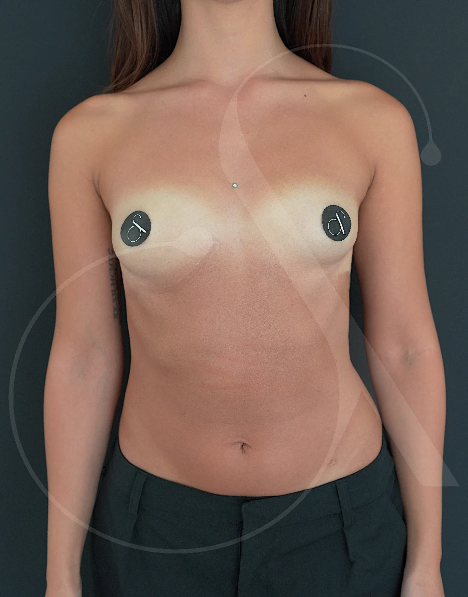 Breast augmentation – Case 19