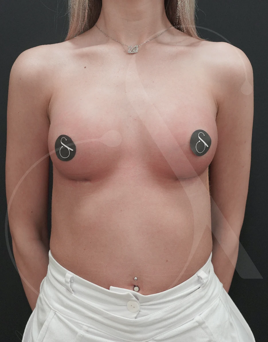 Breast Augmentation – Case 21