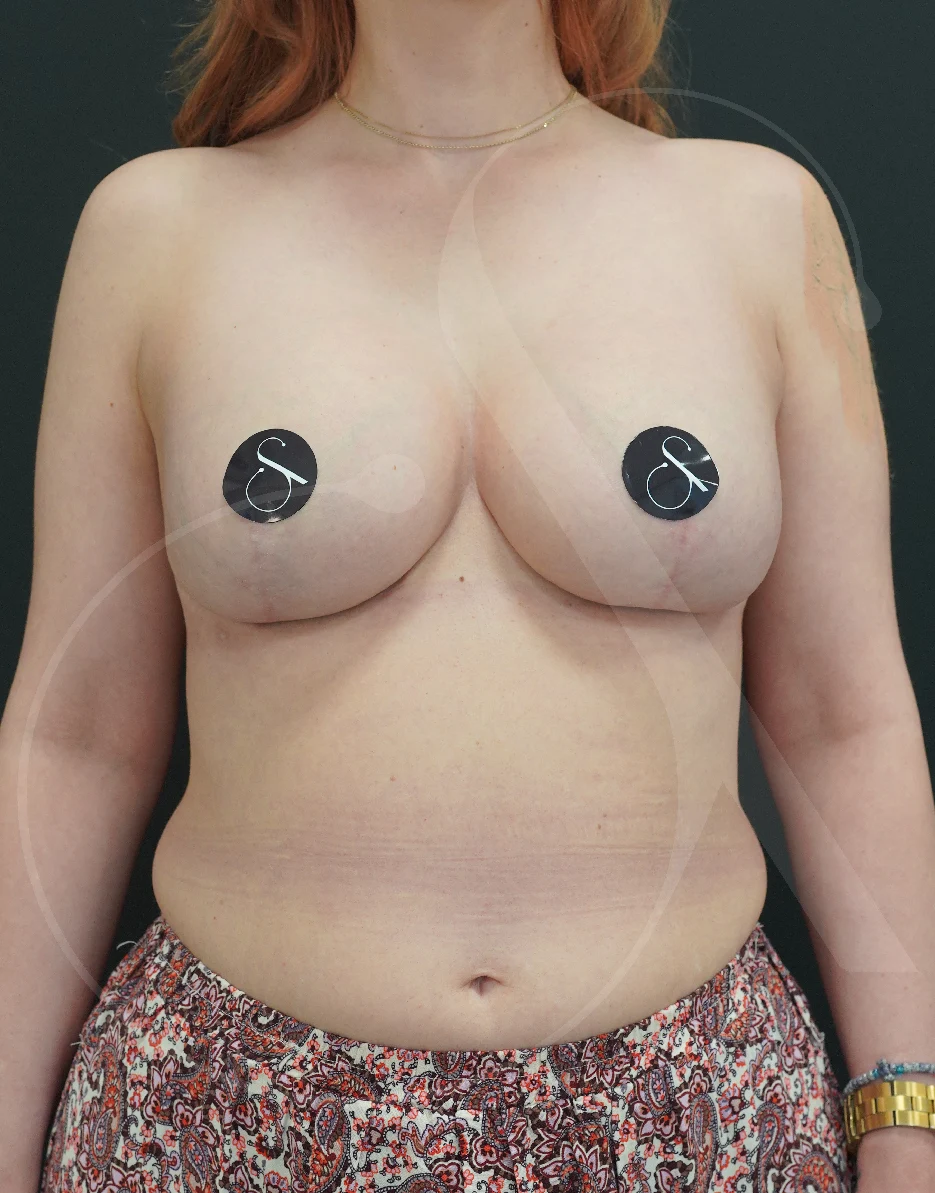Breast Lift with Implants – Case 08