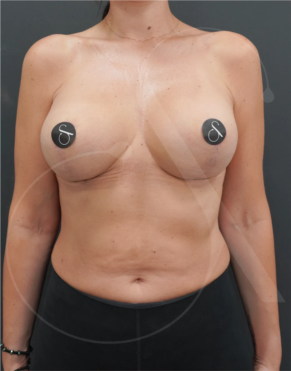 Διορθωτική Επέμβαση Στήθους – Case 01