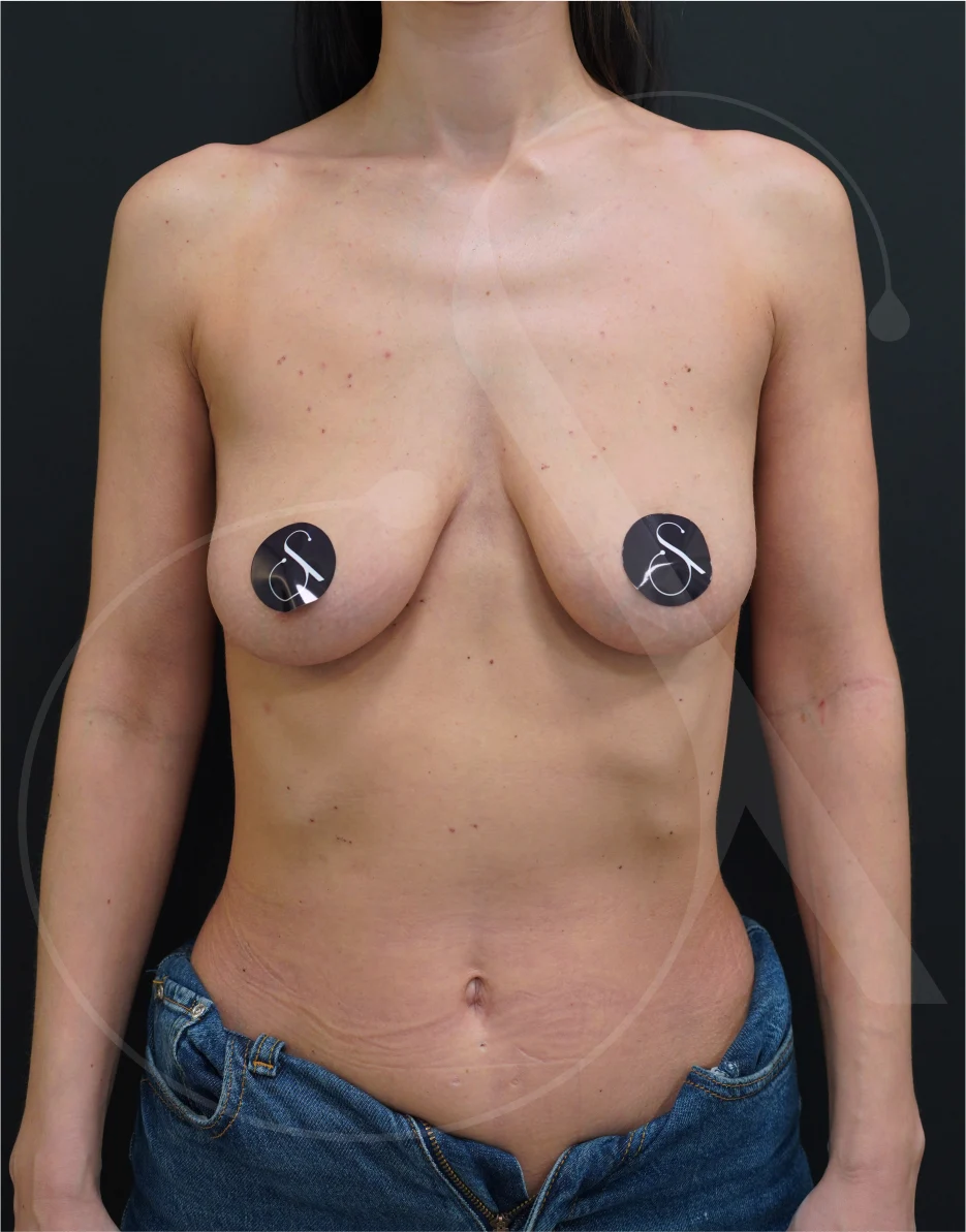 Breast Lift with Implants- Case 12