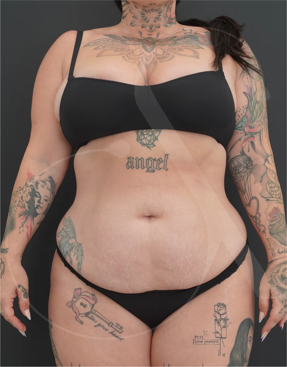 Κοιλιοπλαστική – Case 05