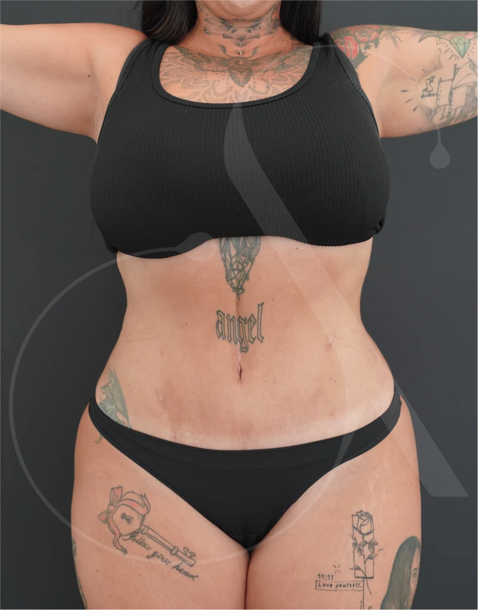 Κοιλιοπλαστική – Case 05