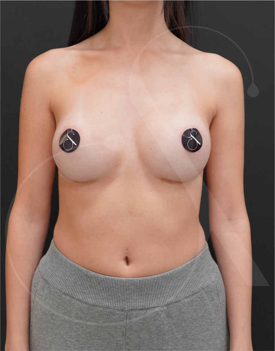 Breast Augmentation – Case 26