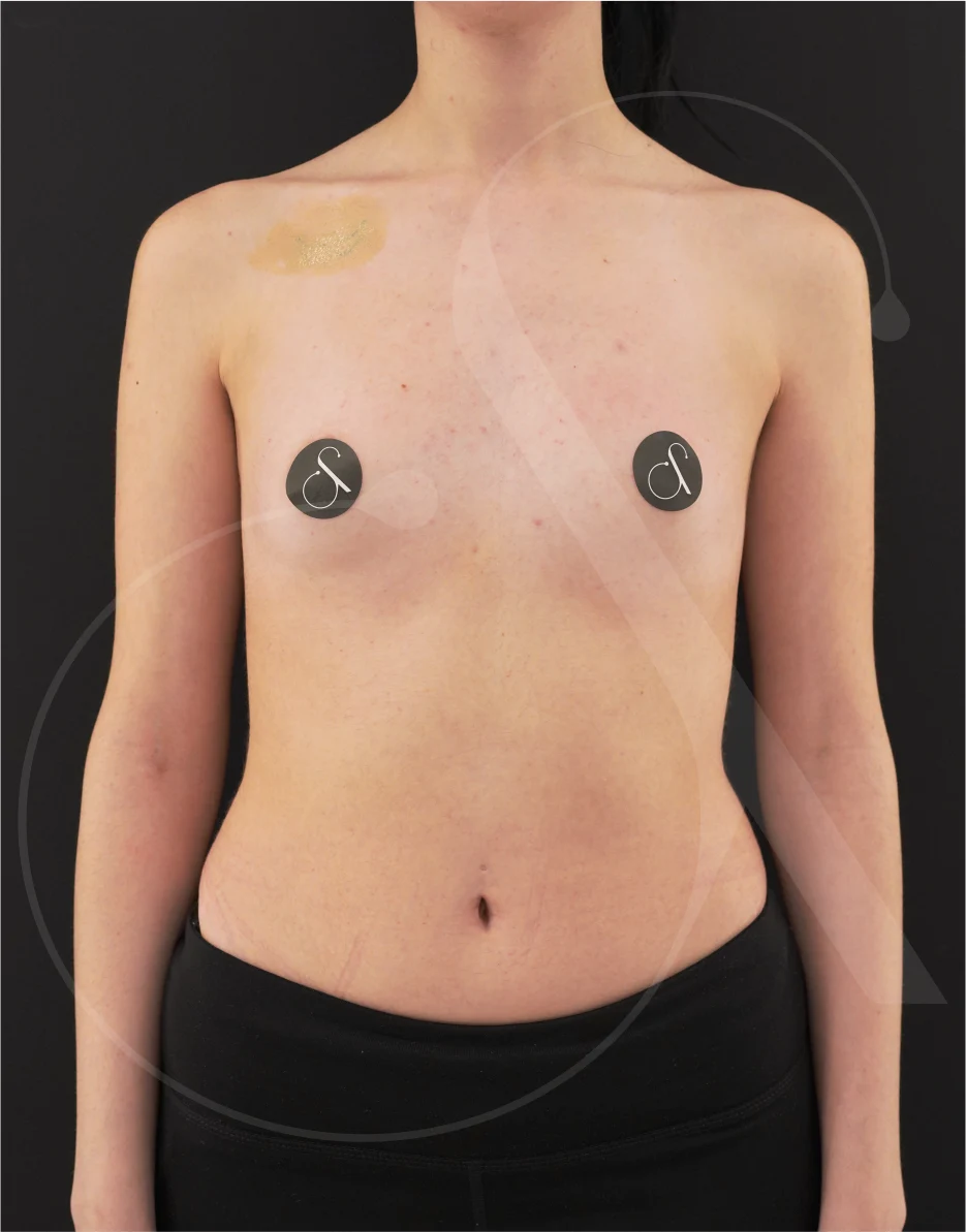 Breast Augmentation – Case 26