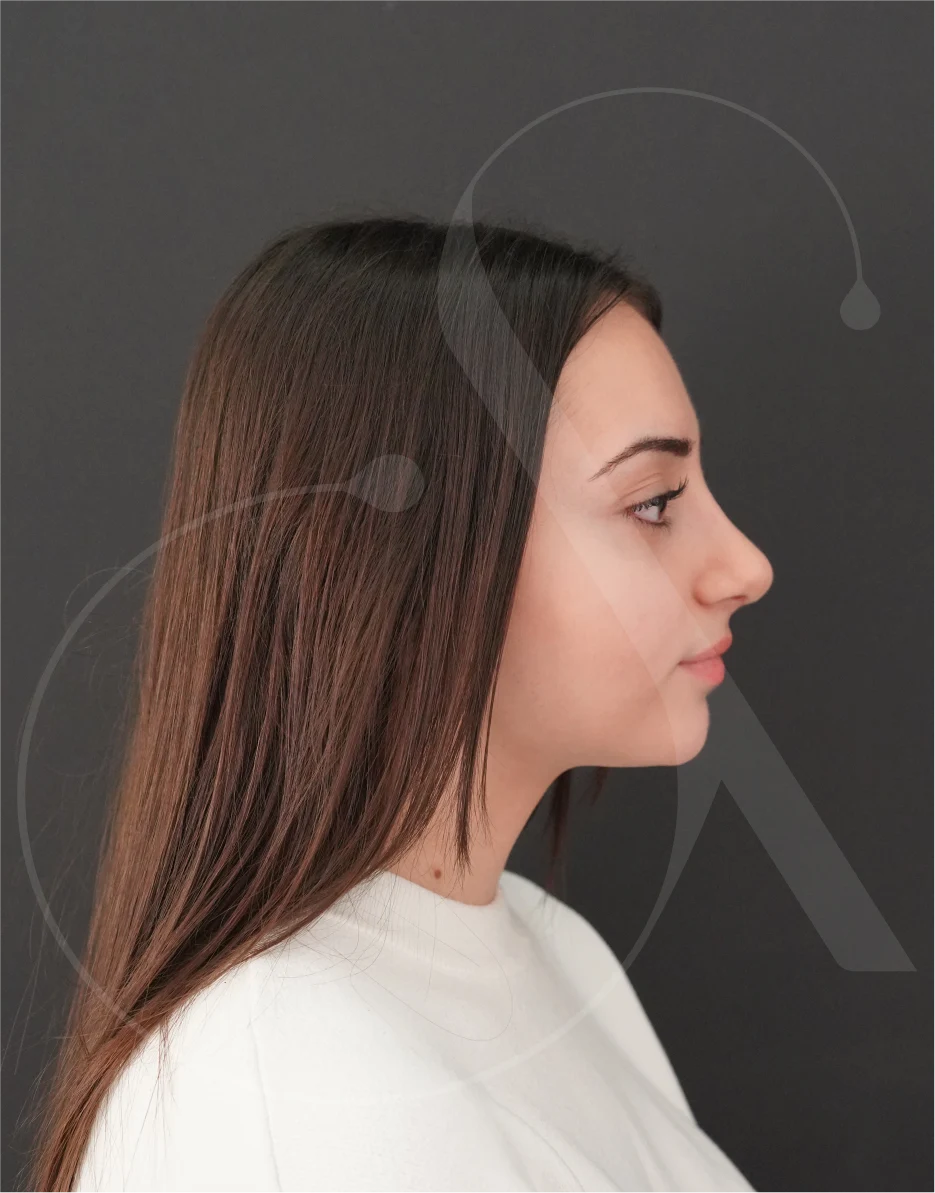 Ρινοπλαστική – Case 06