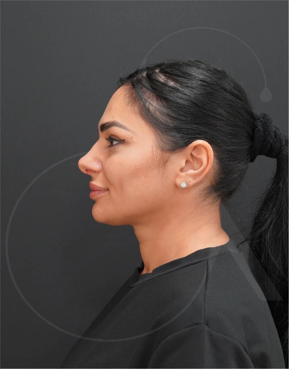 Ρινοπλαστική – Case 05