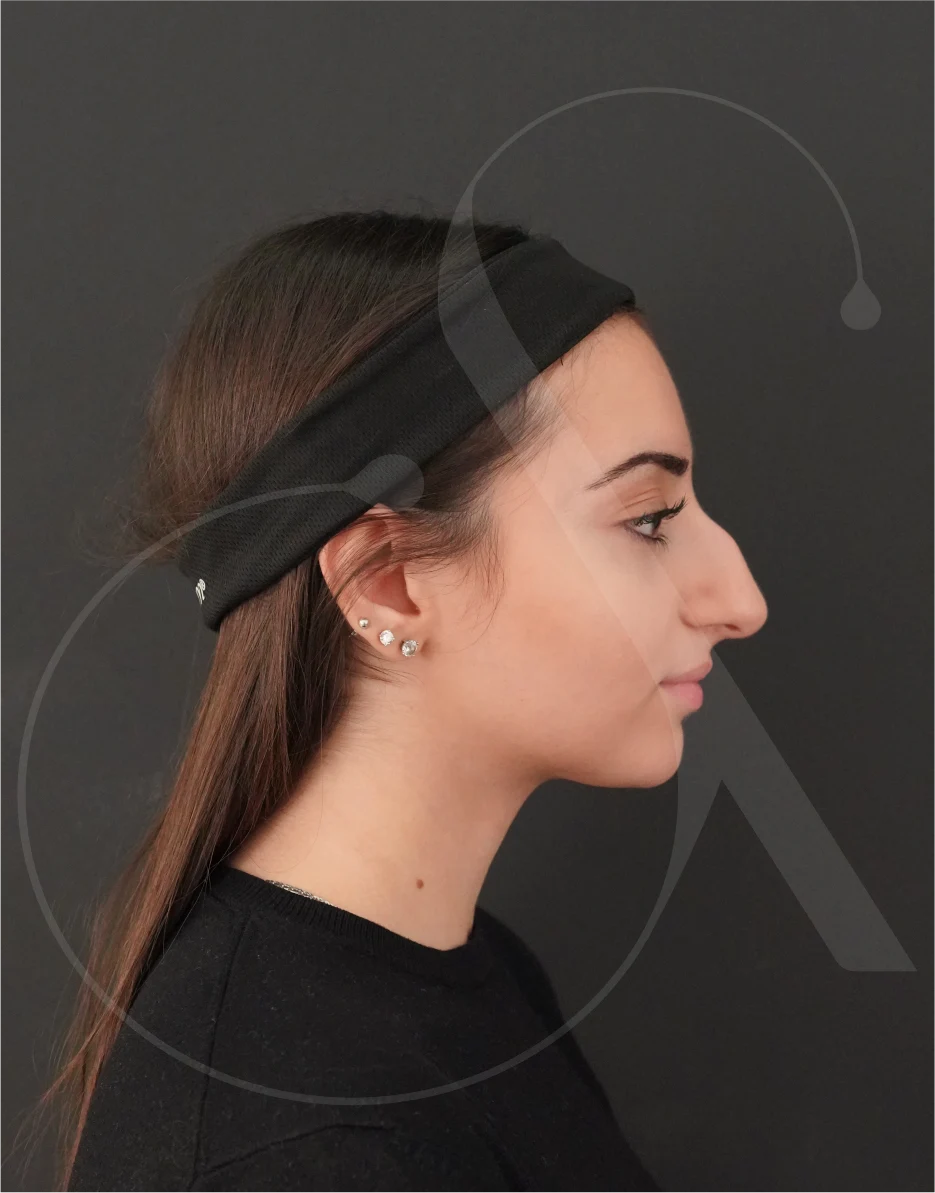 Ρινοπλαστική – Case 06