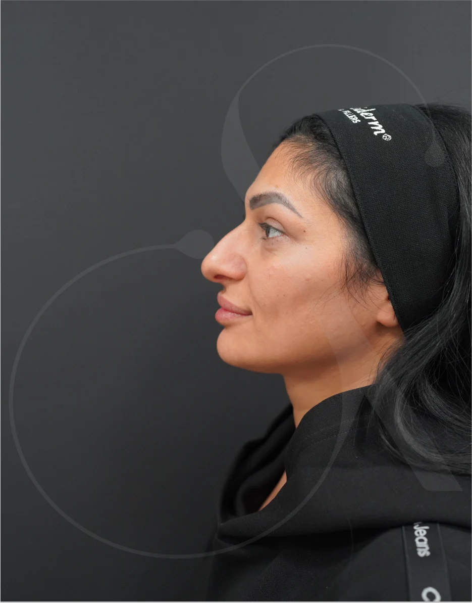 Ρινοπλαστική – Case 05