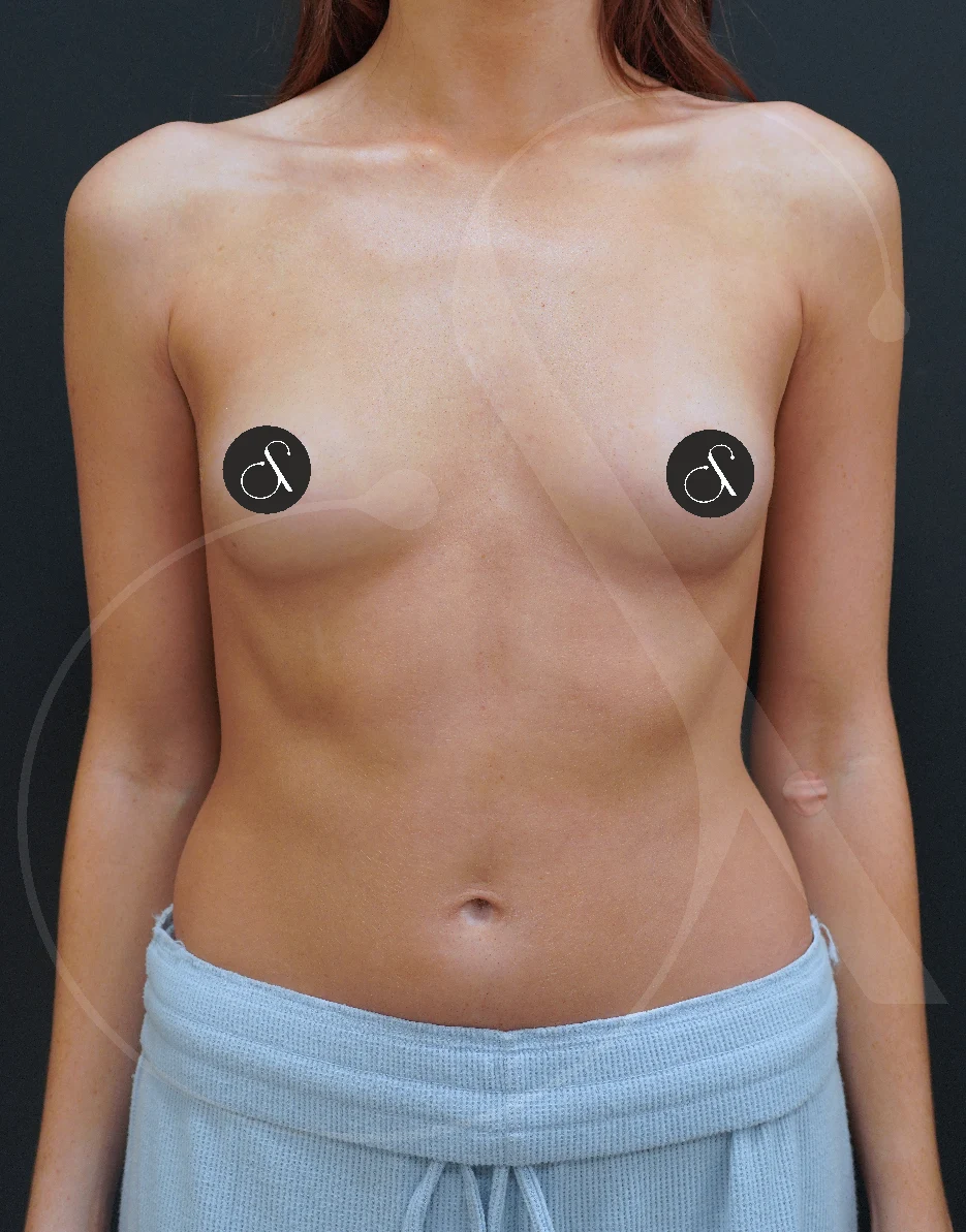 MIA Femtech™ Breast Harmonization – Case 01