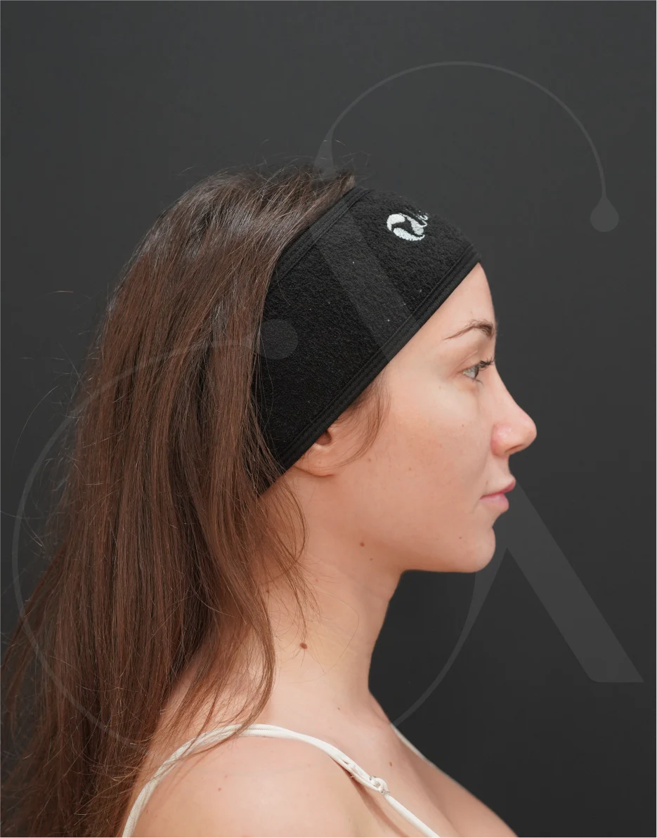 Ρινοπλαστική – Case 07