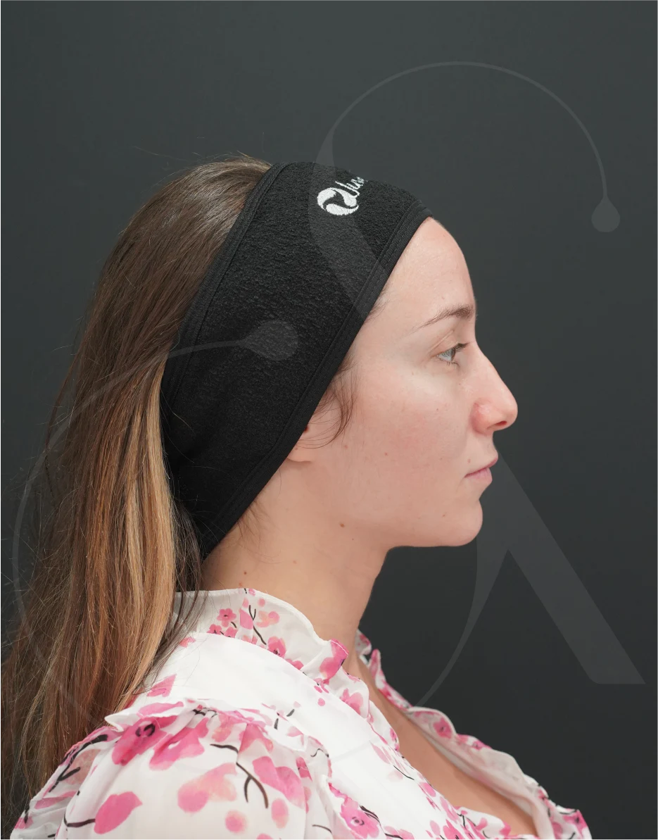 Ρινοπλαστική – Case 07