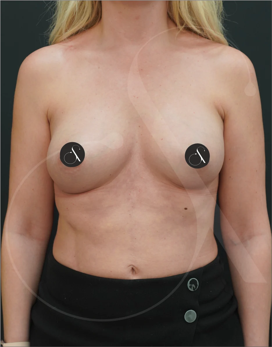 MIA Femtech™ Breast Harmonization – Case 02