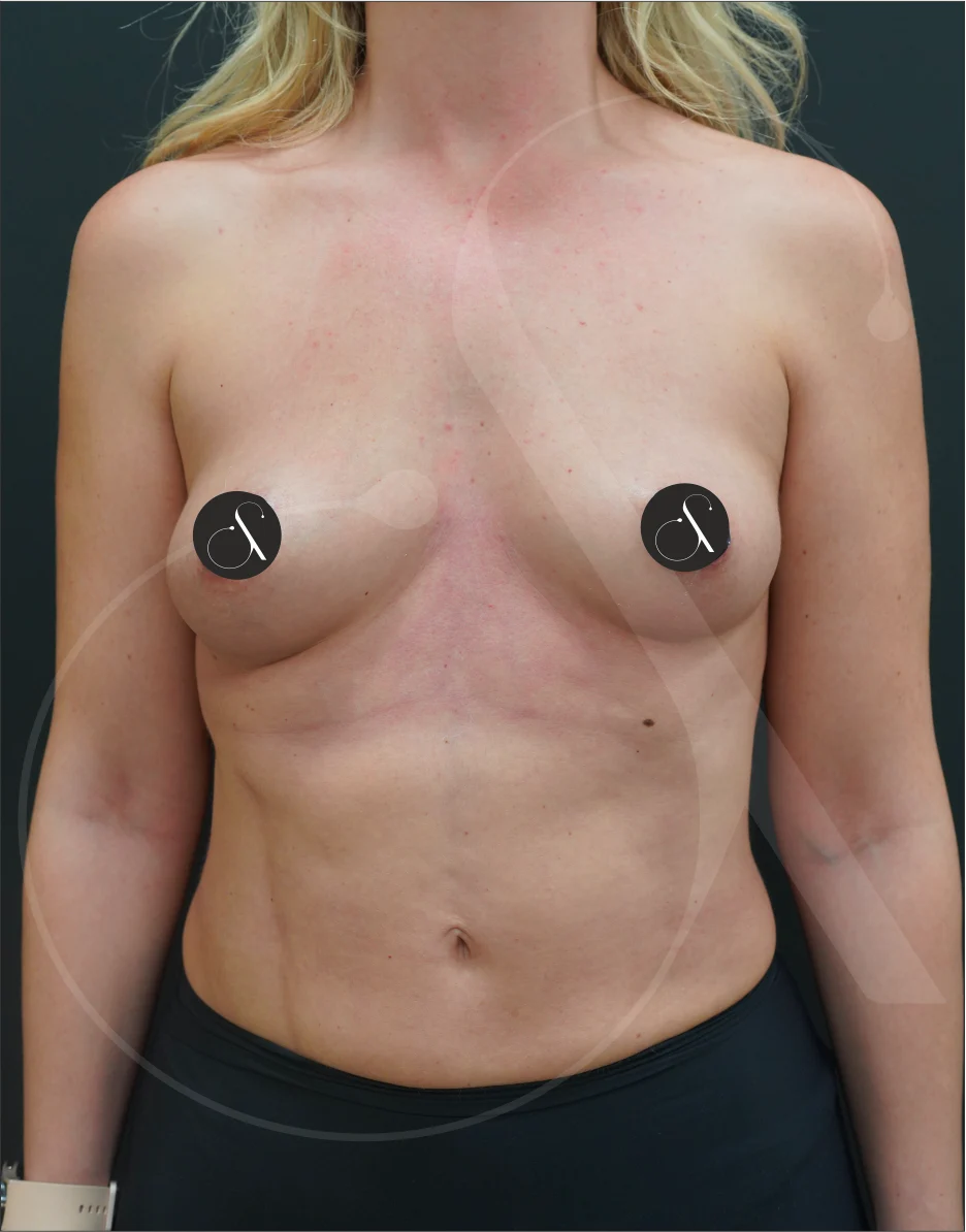 MIA Femtech™ Breast Harmonization – Case 02