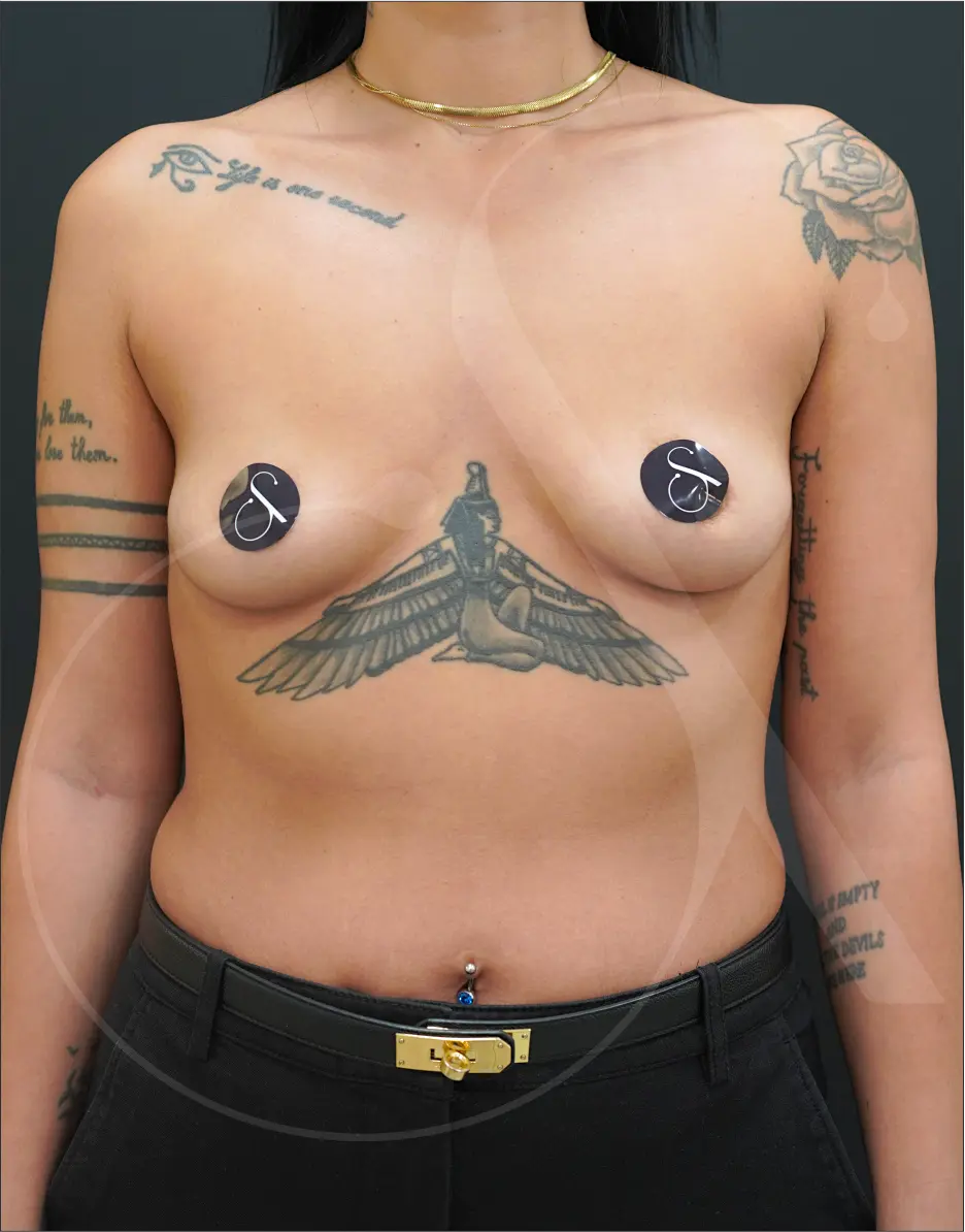 MIA Femtech™ Breast Harmonization – Case 03