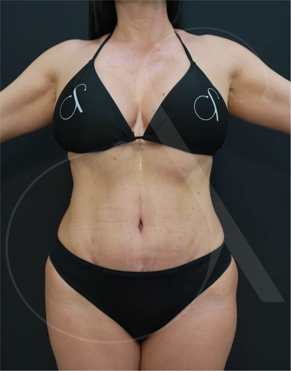 Κοιλιοπλαστική – Case 06