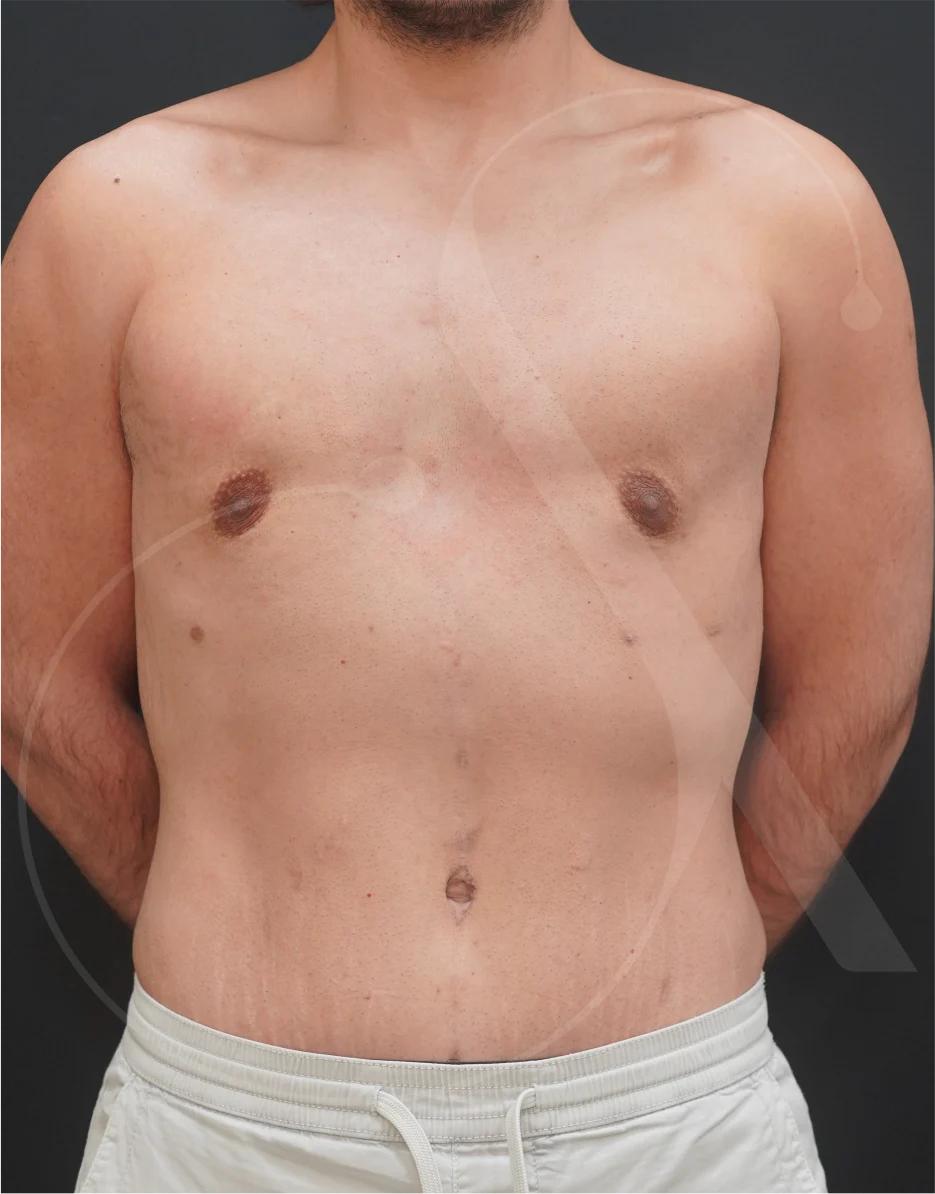 Abdominoplasty – Case 07