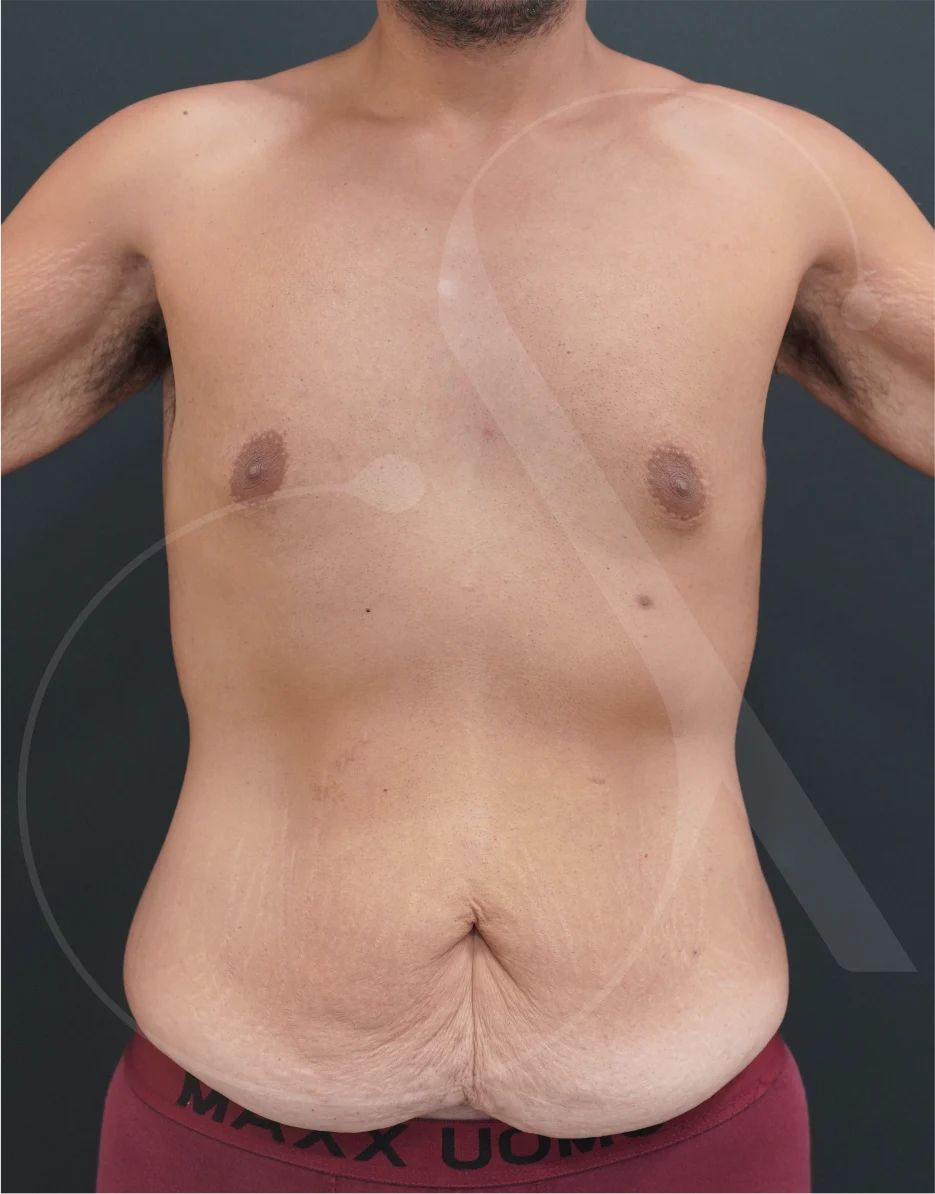 Abdominoplasty – Case 07