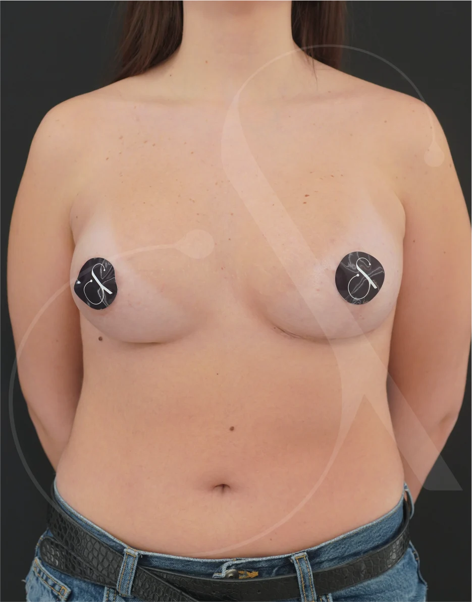 Breast Augmentation – Case 25