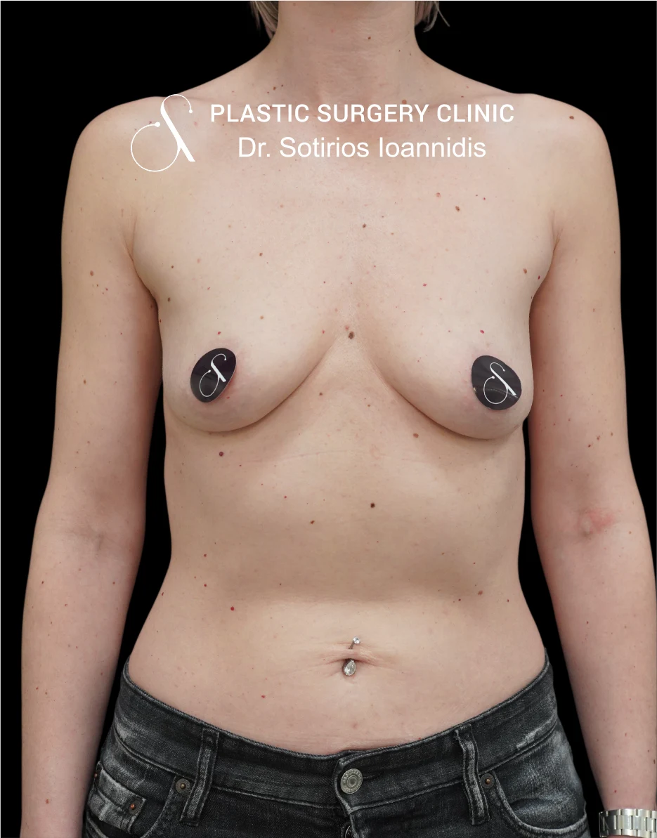 MIA Femtech™ Breast Harmonization – Case 05