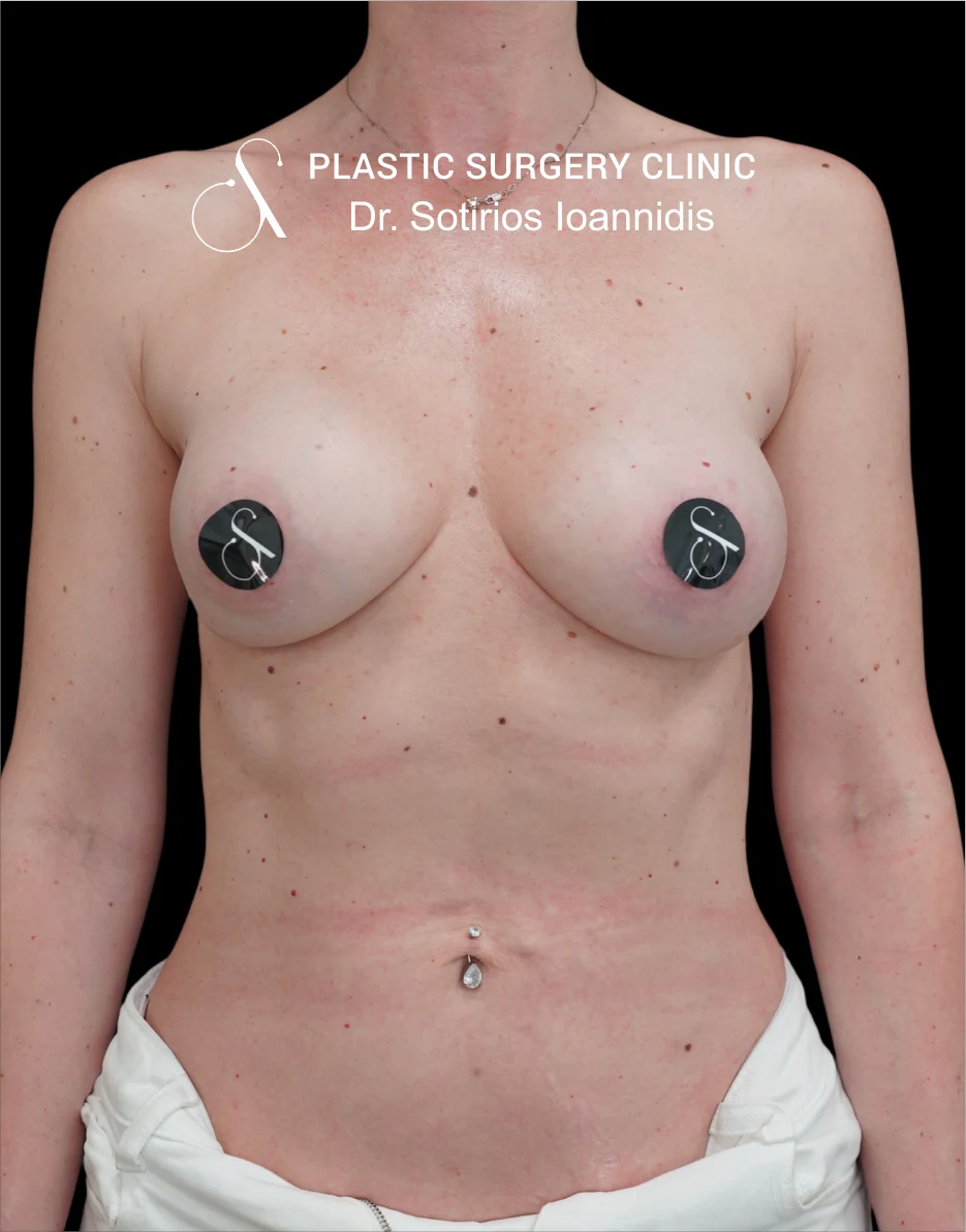 MIA Femtech™ Breast Harmonization – Case 05