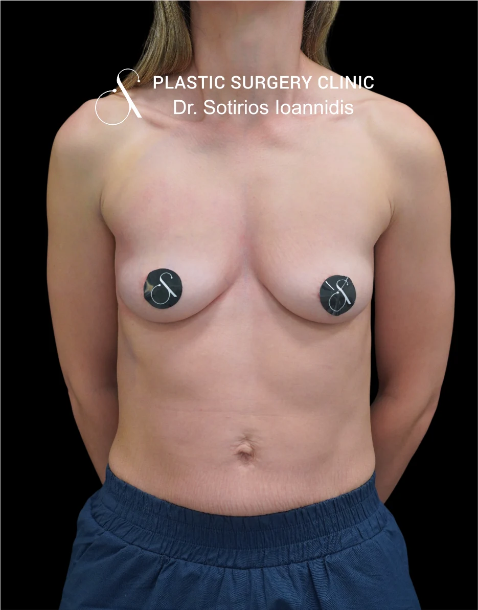 MIA Femtech™ Breast Harmonization – Case 06