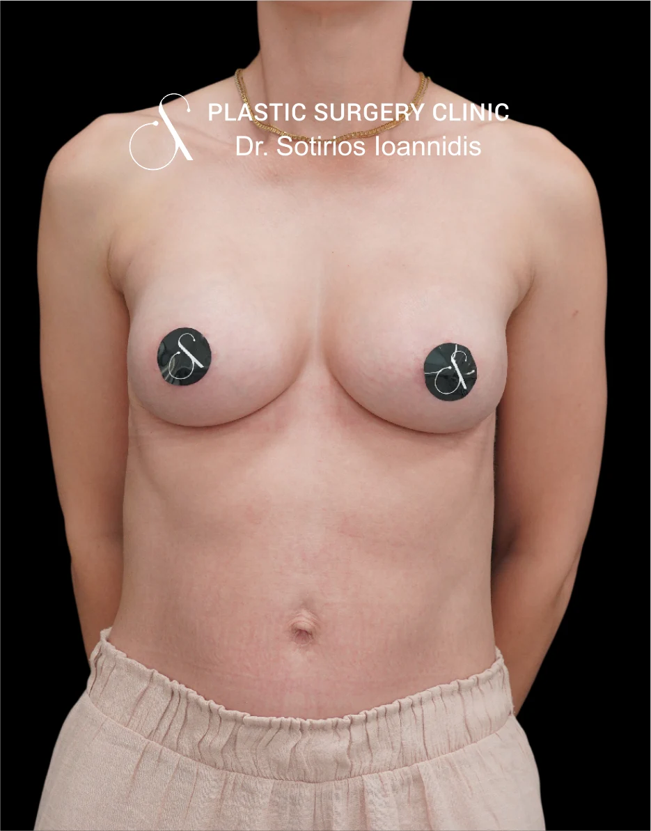 MIA Femtech™ Breast Harmonization – Case 06